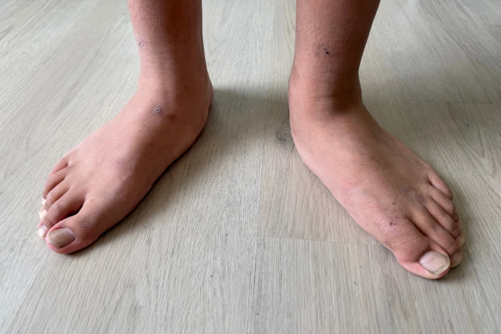 Both bare feet standing on a floor with severely flattened arches, the inner borders collapsed towards the ground, a severe case of flat feet