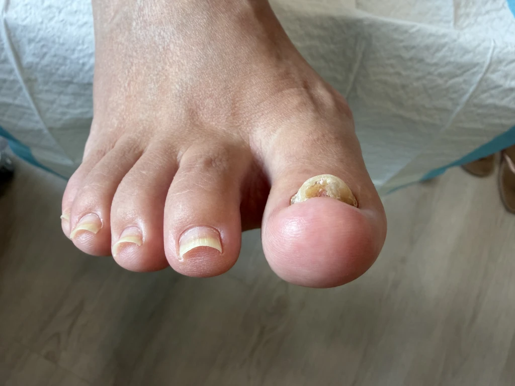 A severely curled right big toenail caused by fungal nail infection