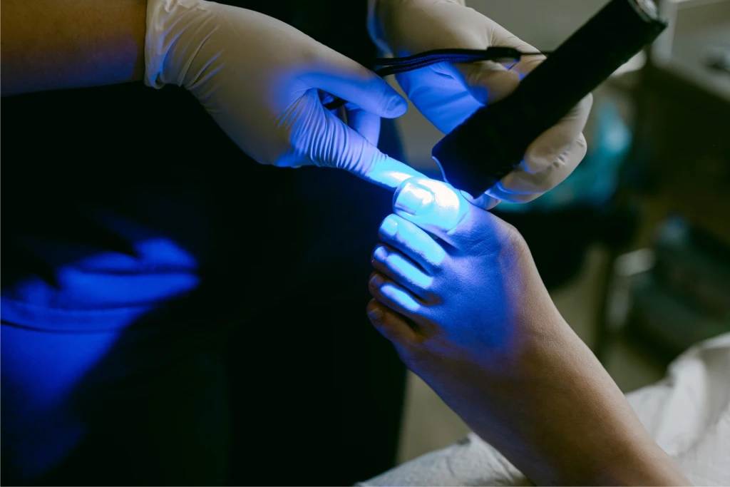 Podiatrist curing a composite nail brace on a toenail, non-surgical ingrown toenail correction at Straits Podiatry Singapore