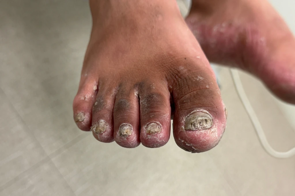 Close-up of several thickened, yellow-brown and crumbly toenails with flaking surrounding skin, changes often caused by a fungal nail infection