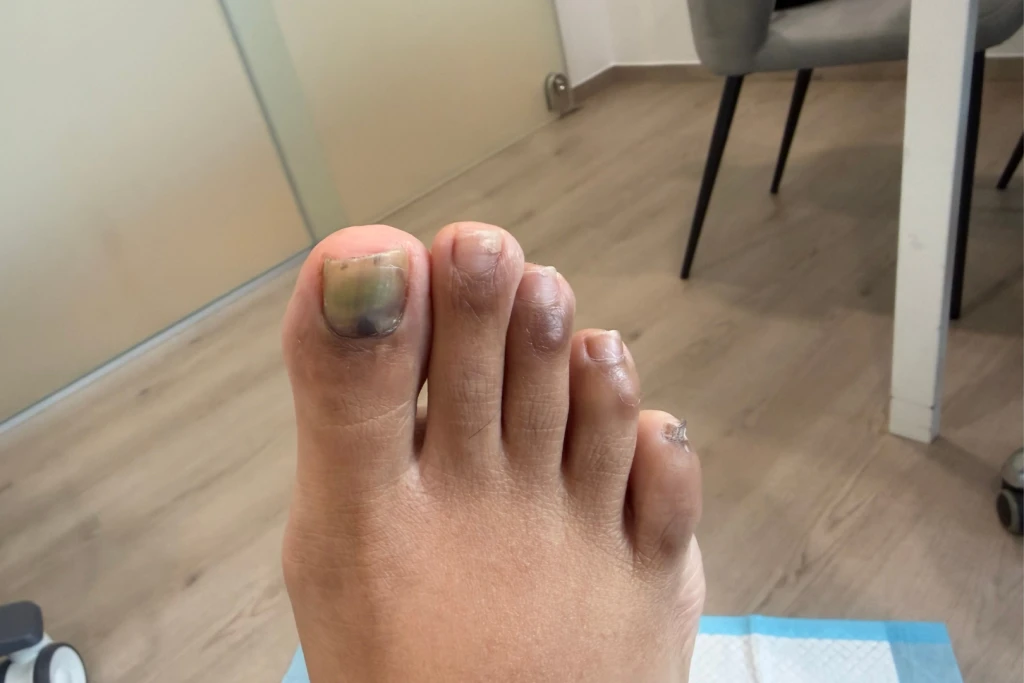 A big toenail with green and dark discolouration spreading across the nail plate, green nail syndrome that developed after a nail injury