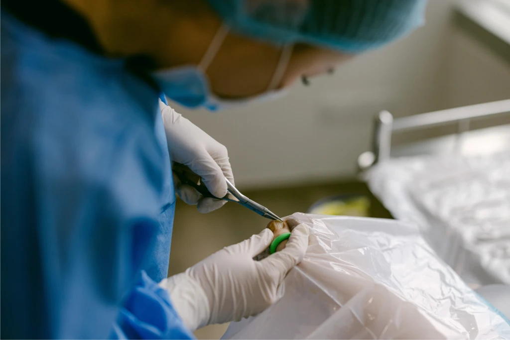 Straits Podiatry podiatrist performing a minor ingrown toenail removal procedure, a partial nail avulsion, under sterile conditions