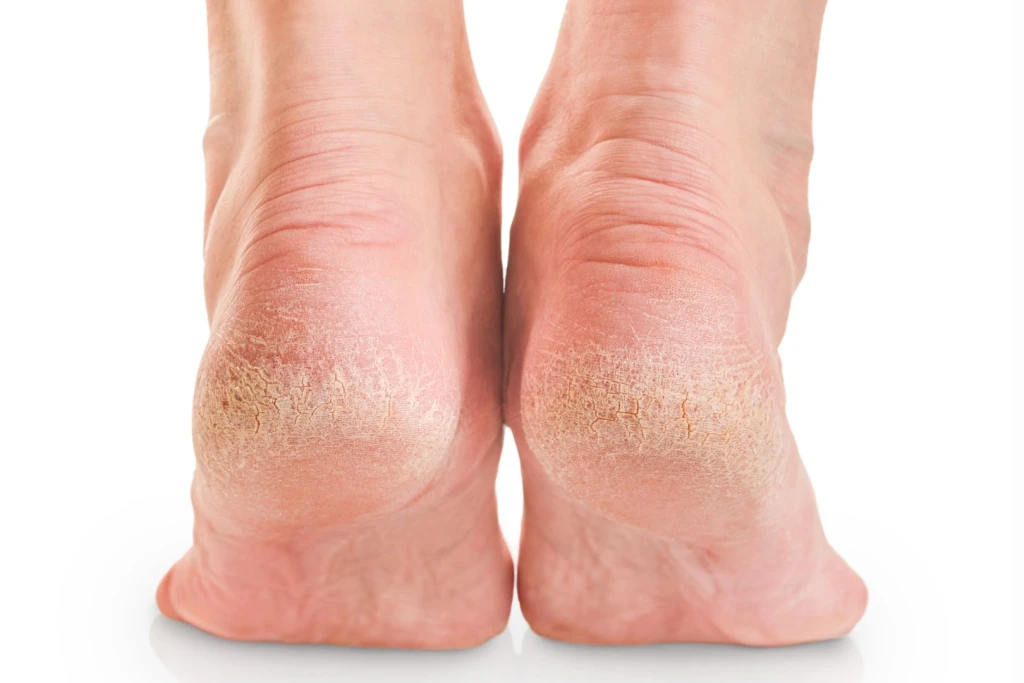 Cracked Heels Symptoms, Causes, and Treatment