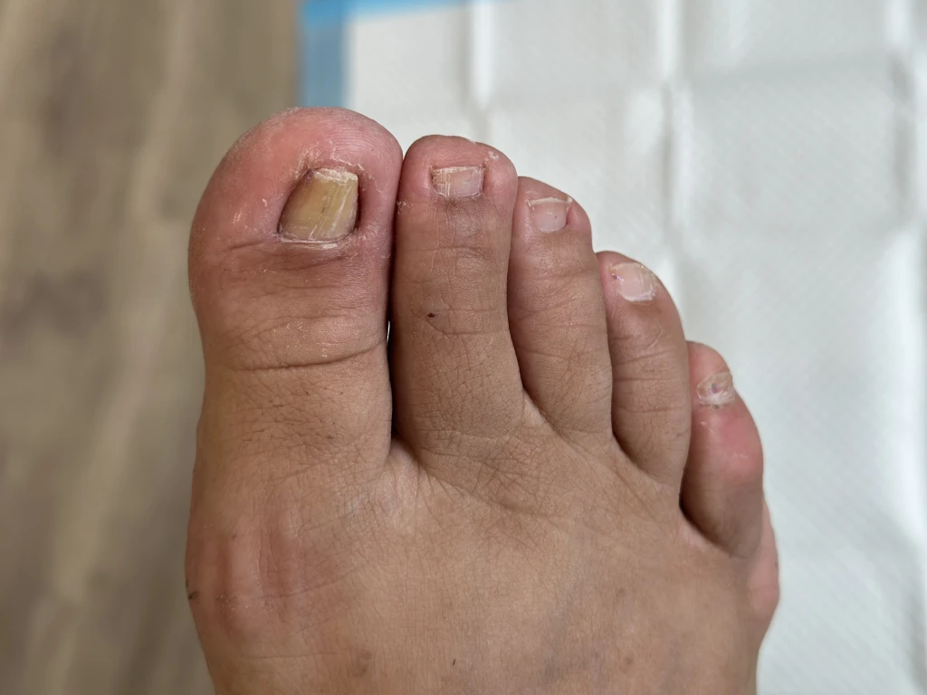 Lady with the a painful right big toenail caused by fungal nail infection and not ingrown toenail