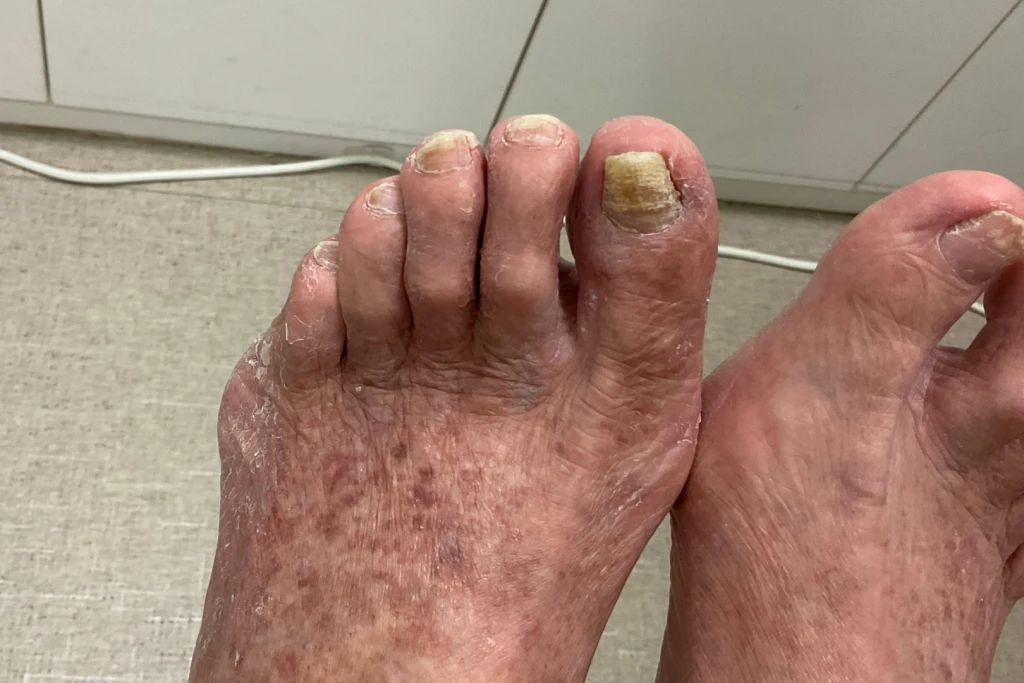 Elderly man with multiple yellowish thickened toenails due to aging and fungal infections