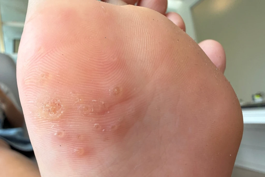 The sole of a foot with a cluster of small round warts, each with a rough surface and tiny central dots that interrupt the skin lines, plantar warts