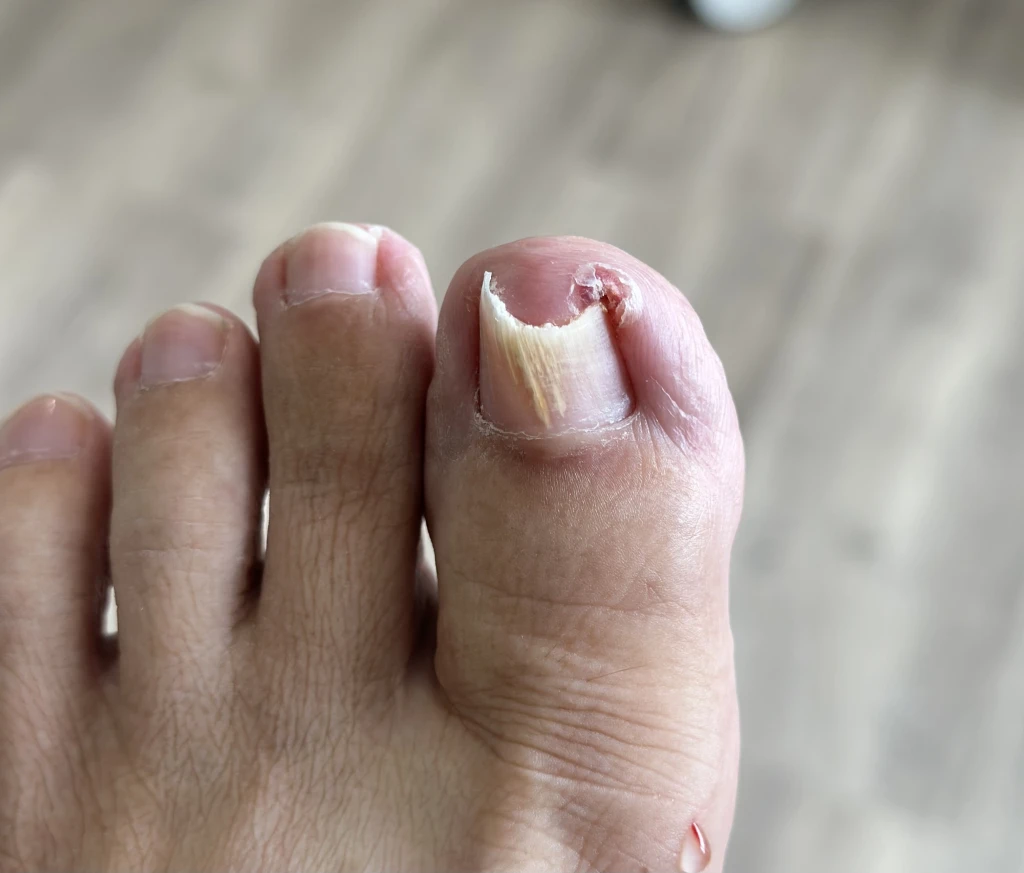 Pincer Nail (Involuted Toenail): Symptoms, Causes, and Treatment