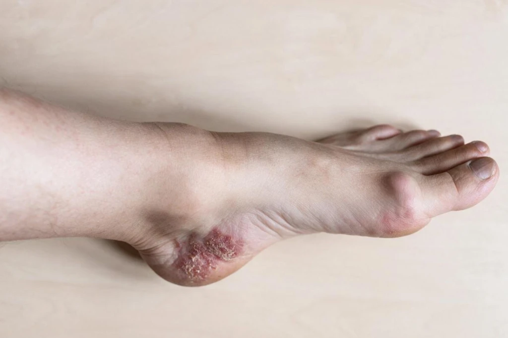 Foot Psoriasis Symptoms, Causes, and Treatment