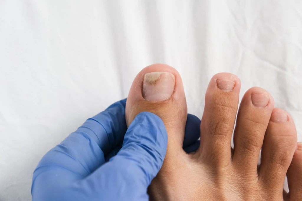 Onycholysis (Lifting Toenail): Symptoms, Causes, and Treatment
