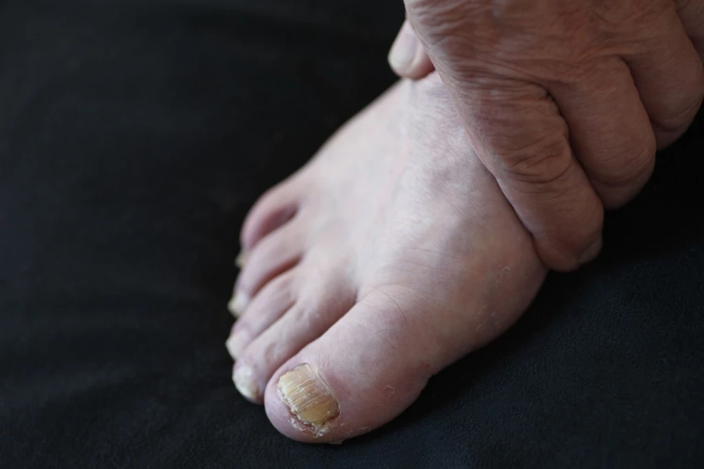 Thickened Toenails (Onychauxis): Symptoms, Causes, and Treatment