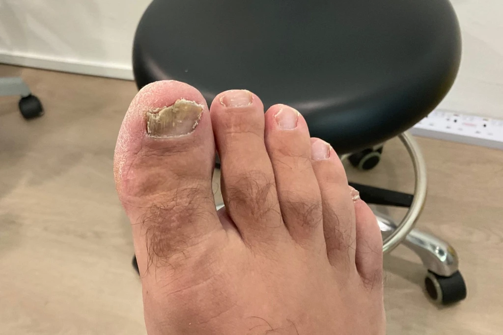 Thickened Toenails (Onychauxis): Symptoms, Causes, and Treatment