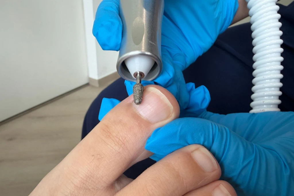 Managing Thickened Toenails (Onychauxis): Symptoms, Causes, and Treatment at Straits Podiatry