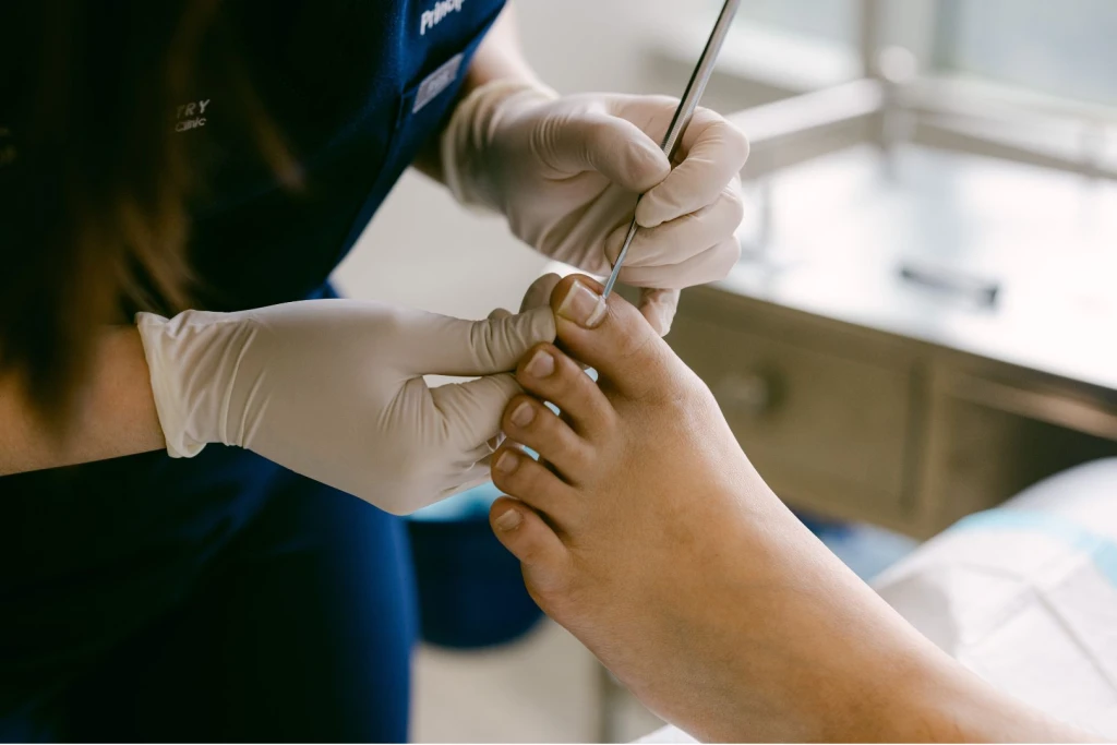 Managing Pincer Nail (Involuted Toenail): Symptoms, Causes, and Treatment at Straits Podiatry