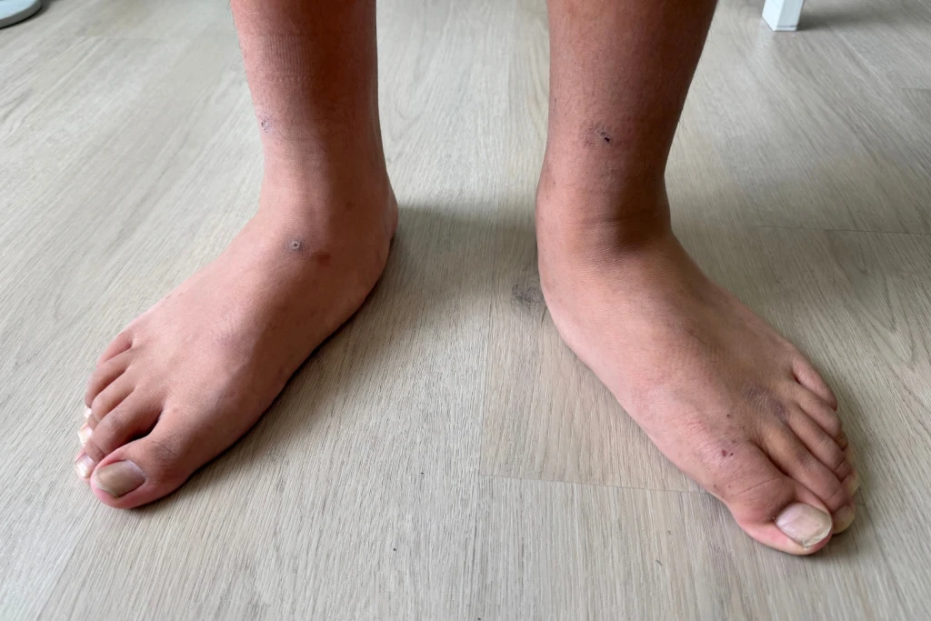 Two bare feet standing side by side, the left foot showing a flatter, more collapsed arch than the right, a sign of a one-sided posterior tibial tendon problem