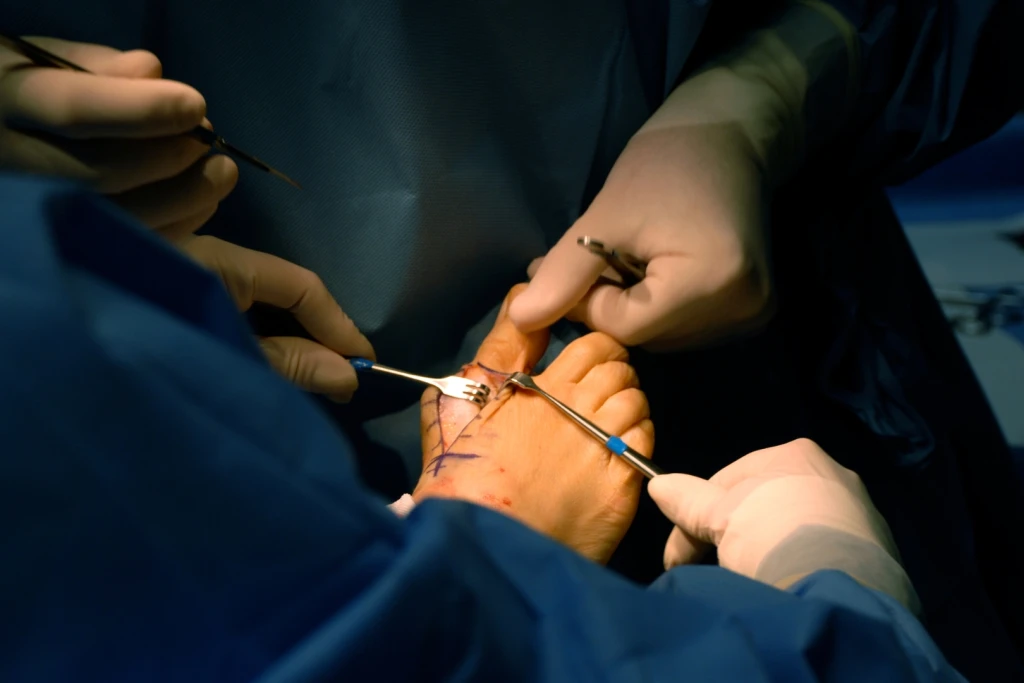 Surgical team operating on a foot during bunion surgery, retractors holding open an incision along the big toe joint marked with surgical pen.
